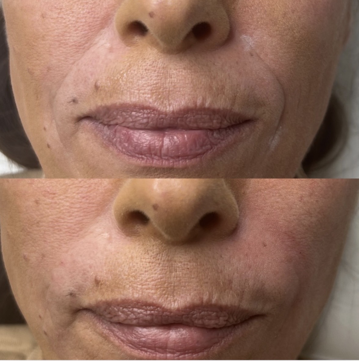 Dermal filler for nasolabial folds before and after result
