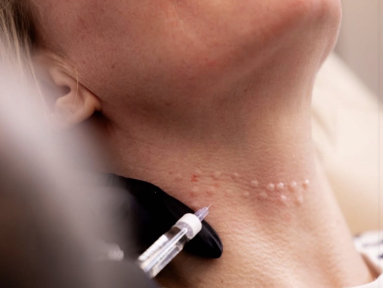 Advanced injectables treatment