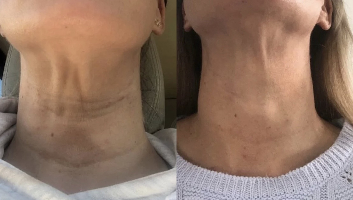 Skin Boosters before and after result